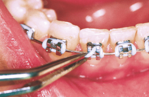 Post-Op Instructions For Orthodontic Appliances