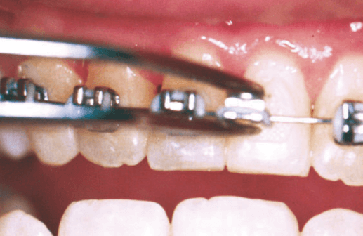 Loose Brackets, Wires or Bands